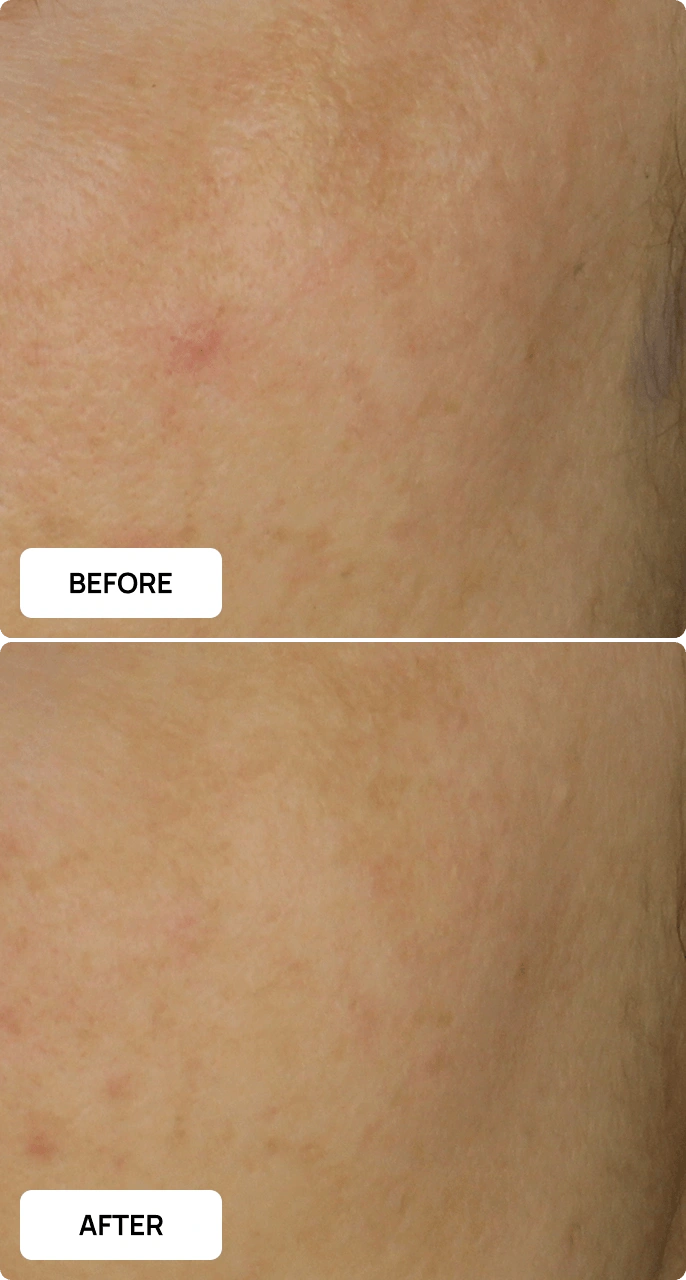 Even Glow before and after