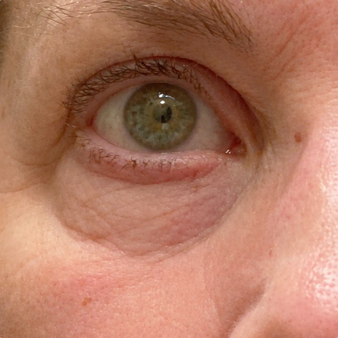Under-eye area without the bundle showing puffiness and dark shadows